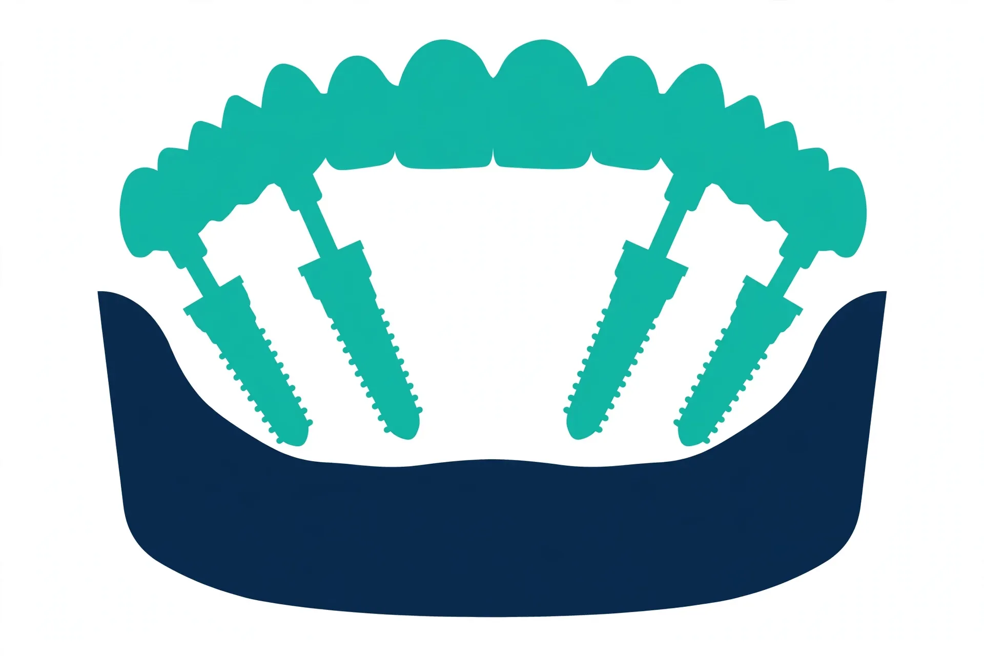 All-on-4 dental implant concept showing four angled implants supporting a full upper arch of fixed teeth