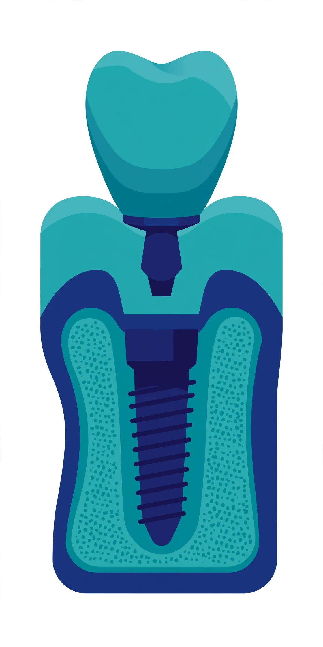Diagram of a dental implant showing the titanium post, abutment, and crown
